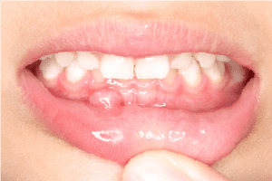 唇や舌にできた水疱の除去